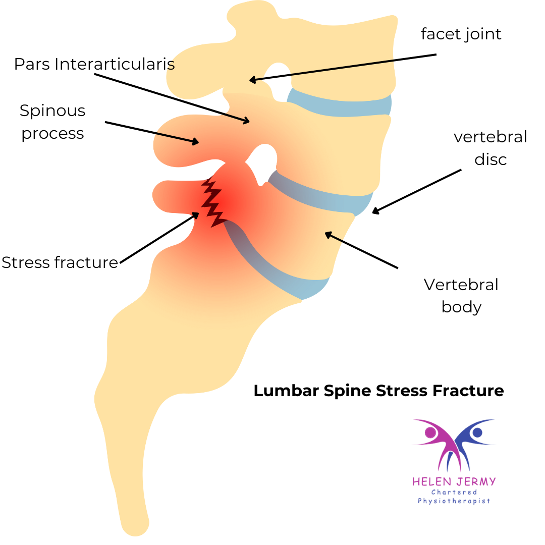 image from Lumbar Spine Bone Stress Injuries and Stress Fractures